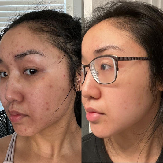 3 weeks apart!! Amazing when used in a regular skincare routine